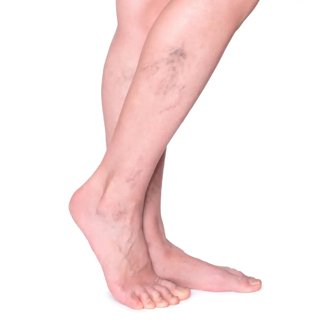 Las varices son más que un problema estético