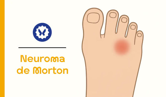 Alivios para el neuroma de morton al utilizar calcetines de compresión sin presión en el pie